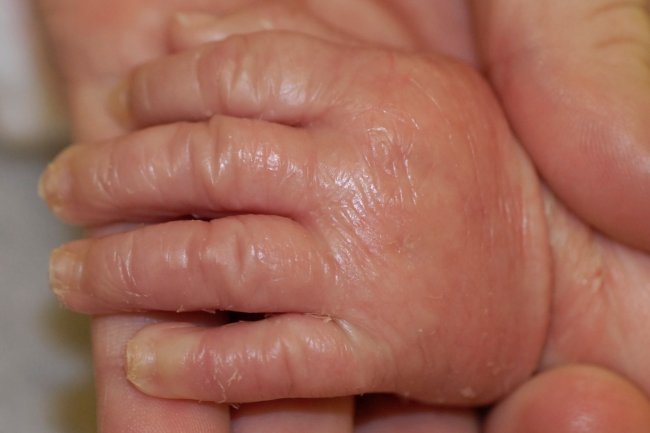 طفل الشمع ..حالة نادرة لمولود جديد في مستشفى المحلة 