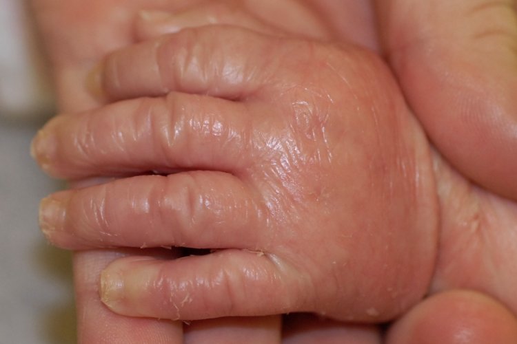 طفل الشمع ..حالة نادرة لمولود جديد في مستشفى المحلة 